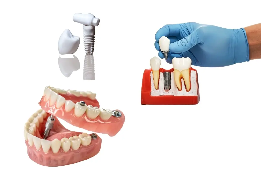 Types of dental implants Antalya, Turkey